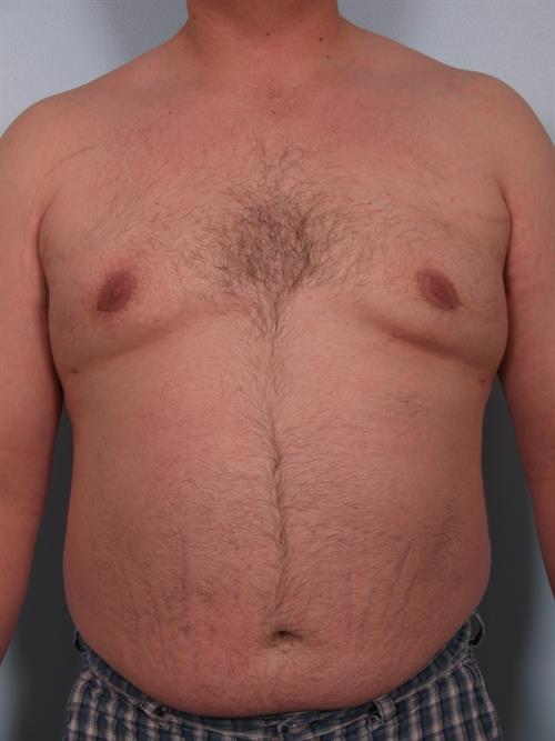 Male Liposuction After Photo | ,  | 