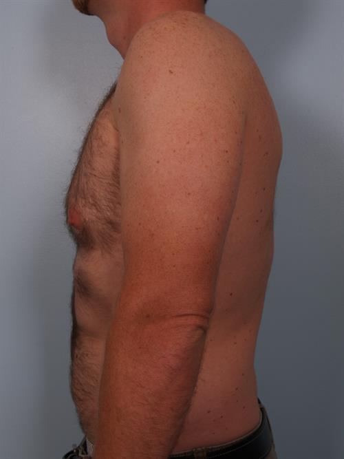 Male Liposuction Before Photo | Phoenix and Scottsdale, AZ | Scottsdale Center for Plastic Surgery