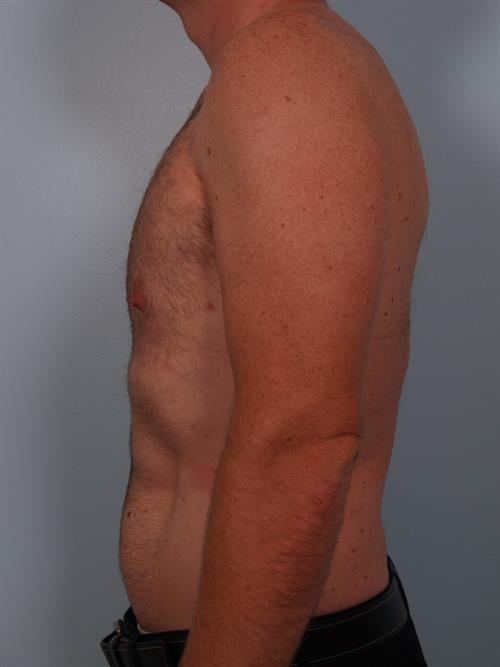 Male Liposuction After Photo | Phoenix and Scottsdale, AZ | Scottsdale Center for Plastic Surgery