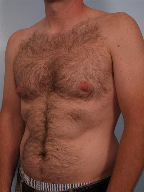Male Liposuction Before Photo | Phoenix and Scottsdale, AZ | Scottsdale Center for Plastic Surgery