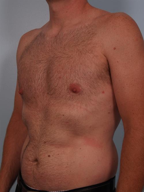 Male Liposuction After Photo | Phoenix and Scottsdale, AZ | Scottsdale Center for Plastic Surgery