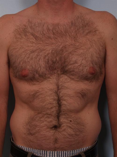 Male Liposuction Before Photo | Phoenix and Scottsdale, AZ | Scottsdale Center for Plastic Surgery