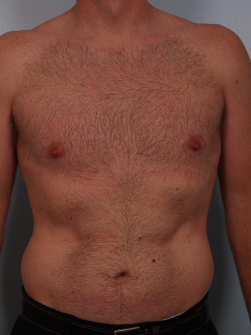 Male Liposuction After Photo | Phoenix and Scottsdale, AZ | Scottsdale Center for Plastic Surgery