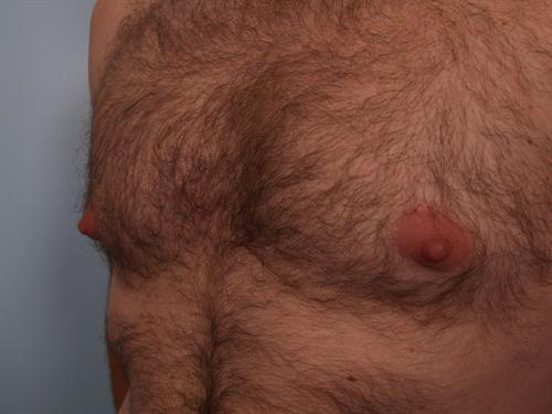 Male Liposuction Before Photo | Phoenix and Scottsdale, AZ | Scottsdale Center for Plastic Surgery
