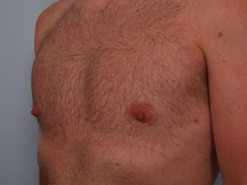 Male Liposuction After Photo | ,  | 