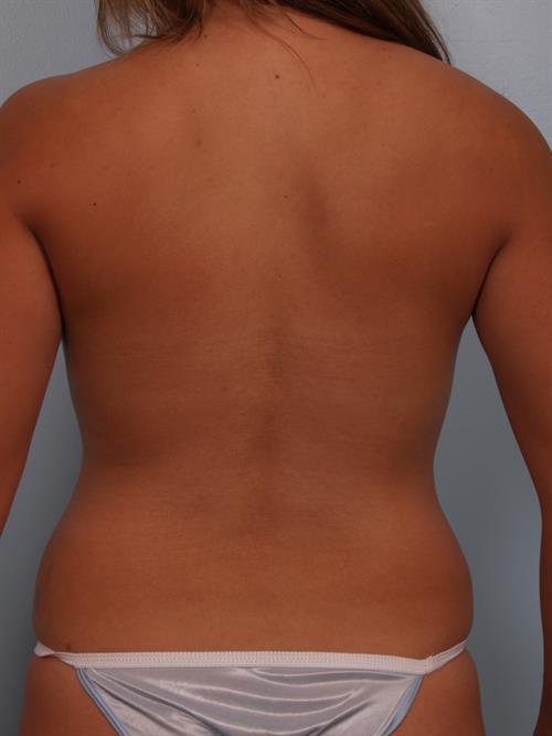 Power Assisted Liposuction Before Photo | Phoenix and Scottsdale, AZ | Scottsdale Center for Plastic Surgery