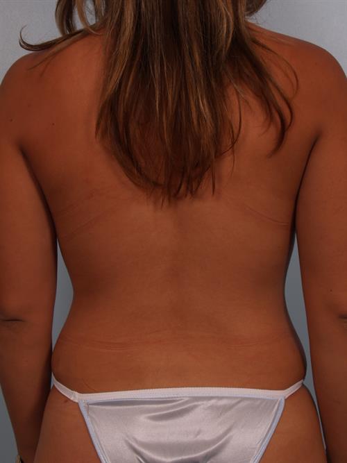 Power Assisted Liposuction After Photo | Phoenix and Scottsdale, AZ | Scottsdale Center for Plastic Surgery