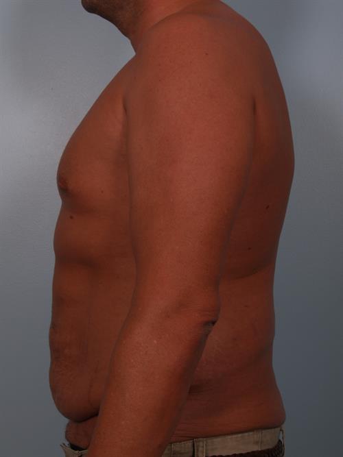 Male Tummy Tuck Before Photo | ,  | 
