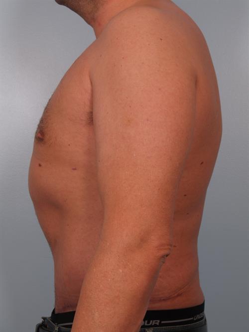 Male Breast/Areola Reduction After Photo | Phoenix and Scottsdale, AZ | Scottsdale Center for Plastic Surgery
