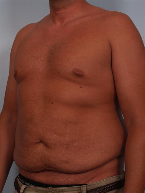 Male Breast/Areola Reduction Before Photo | Phoenix and Scottsdale, AZ | Scottsdale Center for Plastic Surgery