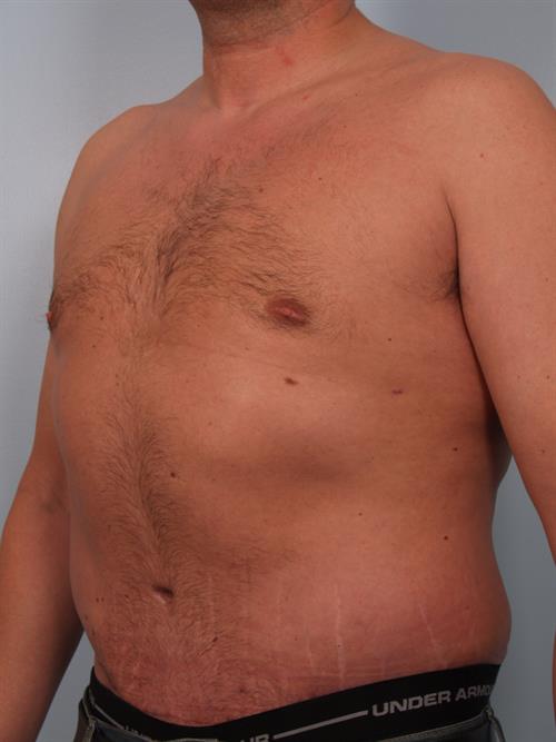 Male Breast/Areola Reduction After Photo | Phoenix and Scottsdale, AZ | Scottsdale Center for Plastic Surgery