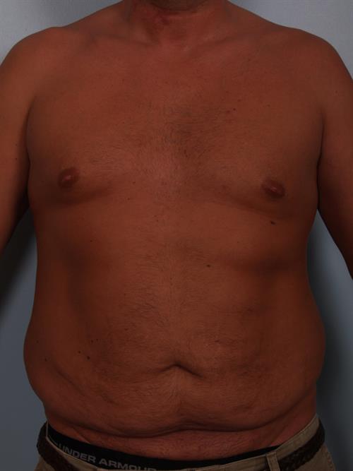 Male Abdominoplasty Girdle – NY Cosmetic Surgery Supplies