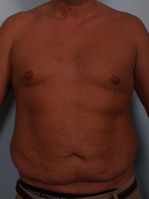 Male Liposuction Before Photo | Phoenix and Scottsdale, AZ | Scottsdale Center for Plastic Surgery
