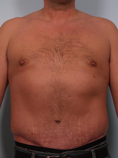 Male Liposuction After Photo | Phoenix and Scottsdale, AZ | Scottsdale Center for Plastic Surgery