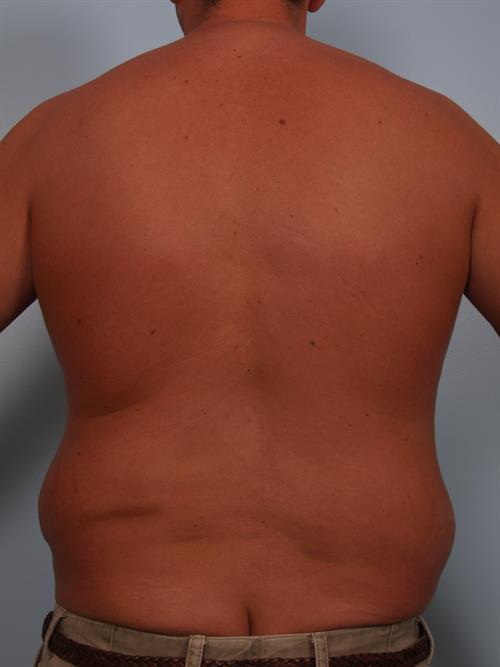 Male Breast/Areola Reduction Before Photo | Phoenix and Scottsdale, AZ | Scottsdale Center for Plastic Surgery