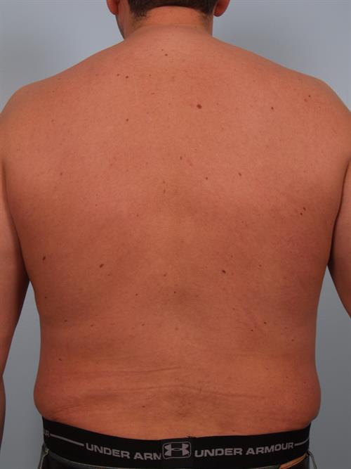 Male Breast/Areola Reduction After Photo | Phoenix and Scottsdale, AZ | Scottsdale Center for Plastic Surgery