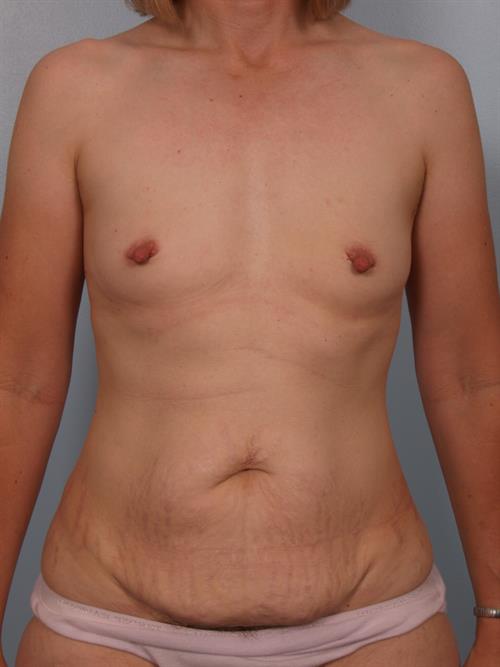 Tummy Tuck Before Photo | Phoenix and Scottsdale, AZ | Scottsdale Center for Plastic Surgery