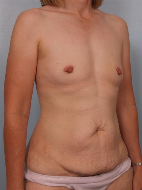 Tummy Tuck Before Photo | Phoenix and Scottsdale, AZ | Scottsdale Center for Plastic Surgery