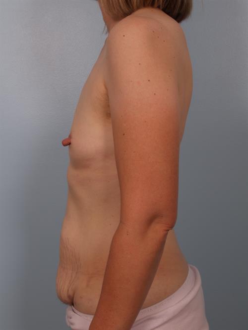 Tummy Tuck Before Photo | Phoenix and Scottsdale, AZ | Scottsdale Center for Plastic Surgery