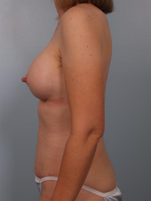 Nipple/Areolar Surgery After Photo | ,  | 