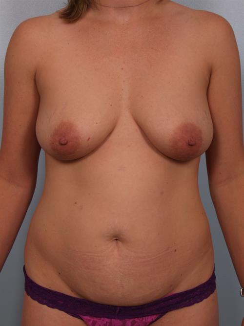 Tummy Tuck Before Photo | Phoenix and Scottsdale, AZ | Scottsdale Center for Plastic Surgery