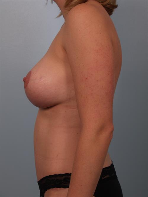 Tummy Tuck After Photo | Phoenix and Scottsdale, AZ | Scottsdale Center for Plastic Surgery