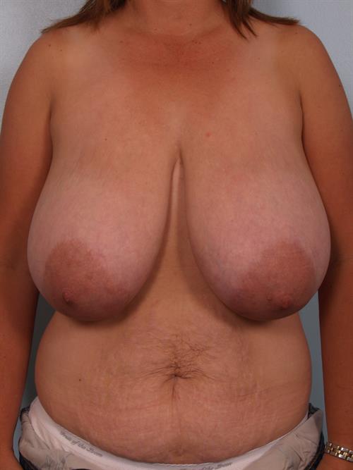 Breast Reduction Before Photo | Phoenix and Scottsdale, AZ | Scottsdale Center for Plastic Surgery