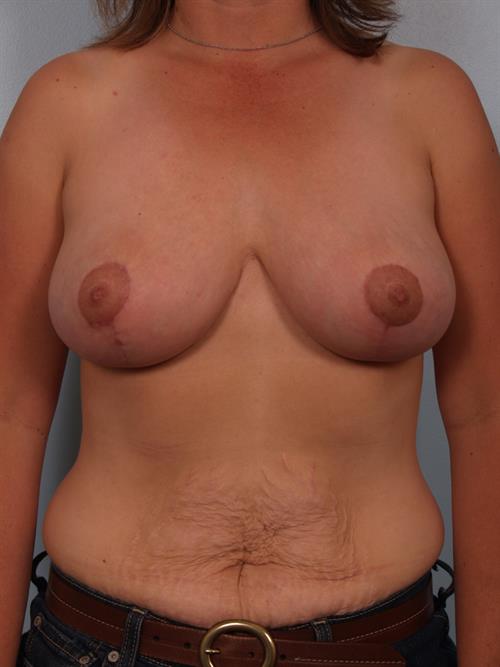 Breast Reduction After Photo | Phoenix and Scottsdale, AZ | Scottsdale Center for Plastic Surgery