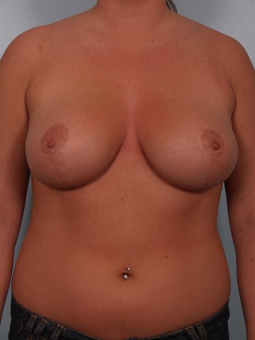 Breast Reduction After Photo | Phoenix and Scottsdale, AZ | Scottsdale Center for Plastic Surgery