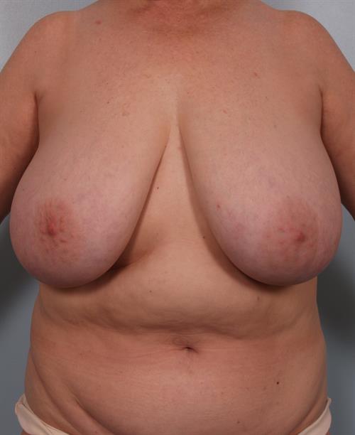 Breast Reduction Before Photo | Phoenix and Scottsdale, AZ | Scottsdale Center for Plastic Surgery