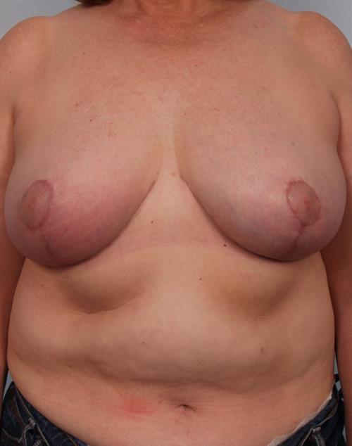 Breast Reduction After Photo | Phoenix and Scottsdale, AZ | Scottsdale Center for Plastic Surgery