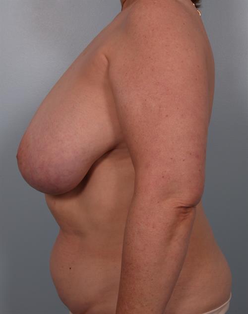 Breast Reduction Before Photo | Phoenix and Scottsdale, AZ | Scottsdale Center for Plastic Surgery