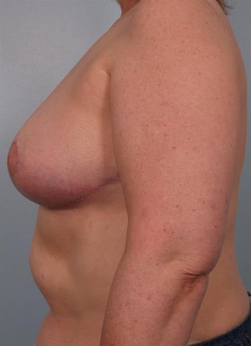 Breast Reduction After Photo | Phoenix and Scottsdale, AZ | Scottsdale Center for Plastic Surgery