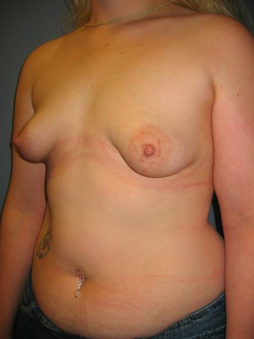 Power Assisted Liposuction Before Photo | Phoenix and Scottsdale, AZ | Scottsdale Center for Plastic Surgery