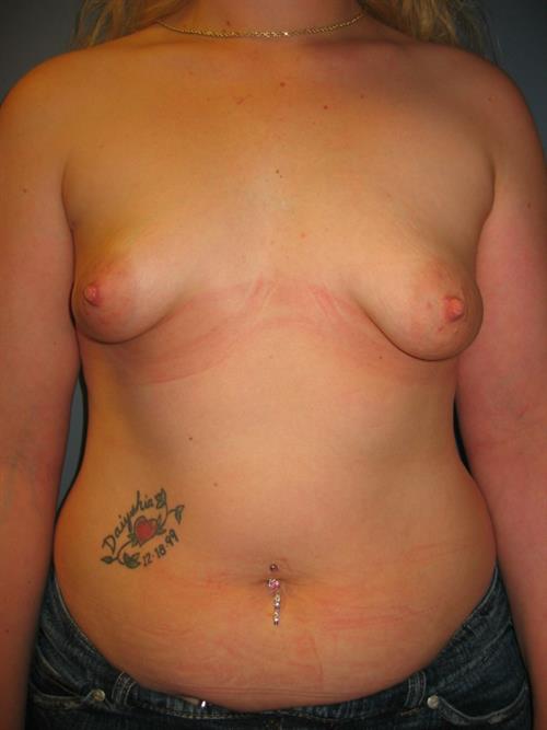 Power Assisted Liposuction Before Photo | Phoenix and Scottsdale, AZ | Scottsdale Center for Plastic Surgery