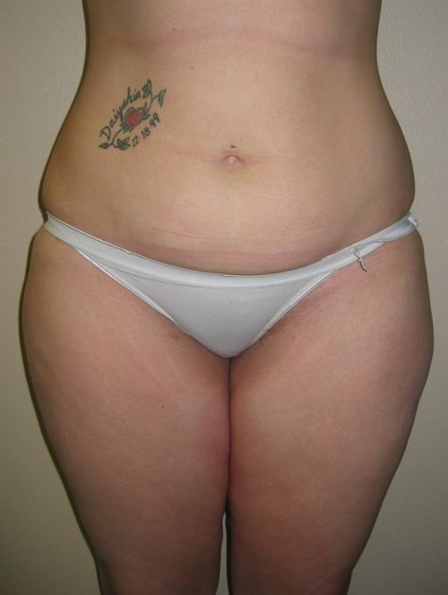 Power Assisted Liposuction Before Photo | Phoenix and Scottsdale, AZ | Scottsdale Center for Plastic Surgery