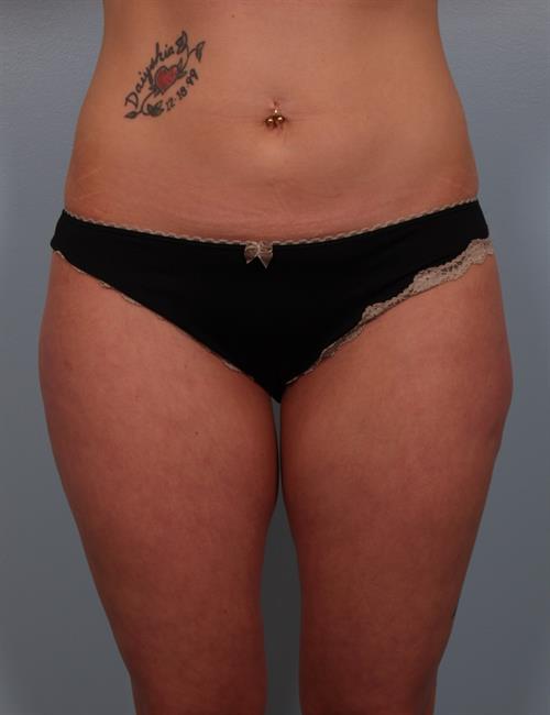 Power Assisted Liposuction After Photo | Phoenix and Scottsdale, AZ | Scottsdale Center for Plastic Surgery