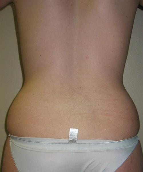 Power Assisted Liposuction Before Photo | Phoenix and Scottsdale, AZ | Scottsdale Center for Plastic Surgery