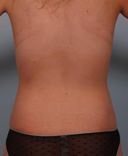 Power Assisted Liposuction After Photo | Phoenix and Scottsdale, AZ | Scottsdale Center for Plastic Surgery