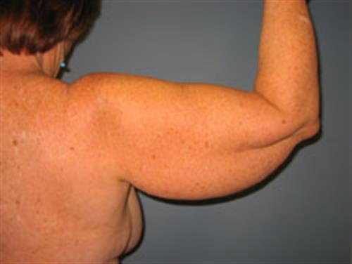 Power Assisted Liposuction Before Photo | Phoenix and Scottsdale, AZ | Scottsdale Center for Plastic Surgery