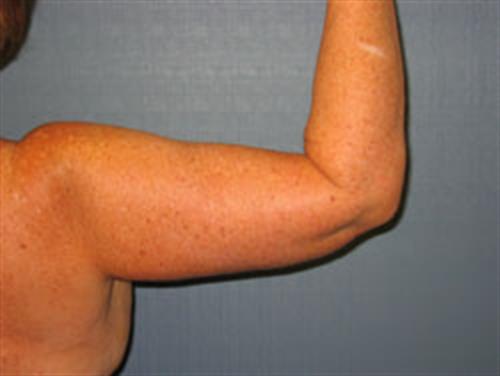 Power Assisted Liposuction After Photo | Phoenix and Scottsdale, AZ | Scottsdale Center for Plastic Surgery