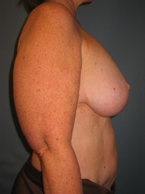Power Assisted Liposuction Before Photo | Phoenix and Scottsdale, AZ | Scottsdale Center for Plastic Surgery