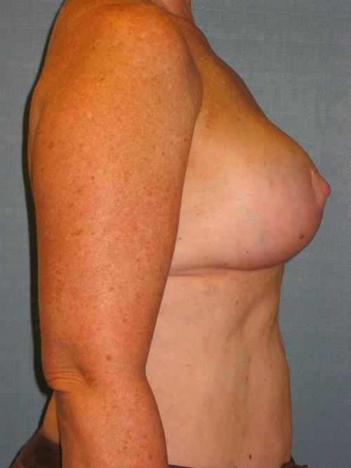 Power Assisted Liposuction After Photo | Phoenix and Scottsdale, AZ | Scottsdale Center for Plastic Surgery