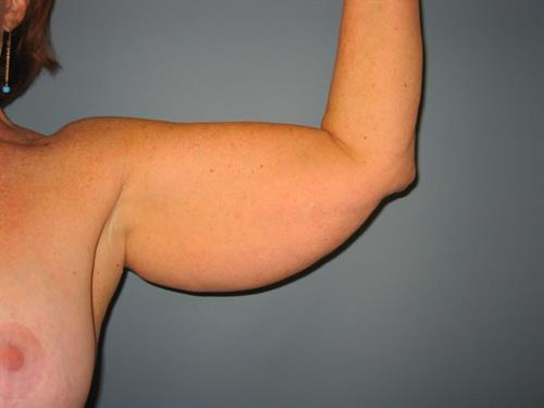 Power Assisted Liposuction Before Photo | Phoenix and Scottsdale, AZ | Scottsdale Center for Plastic Surgery