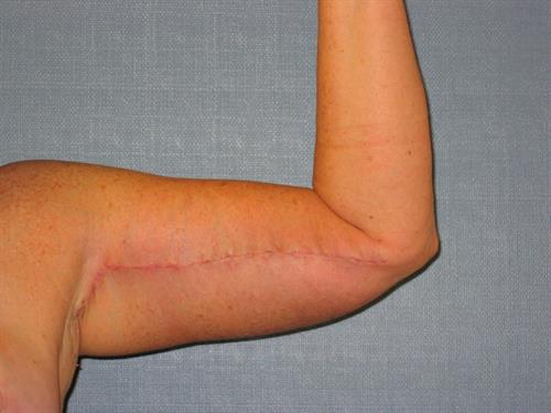 Power Assisted Liposuction After Photo | Phoenix and Scottsdale, AZ | Scottsdale Center for Plastic Surgery