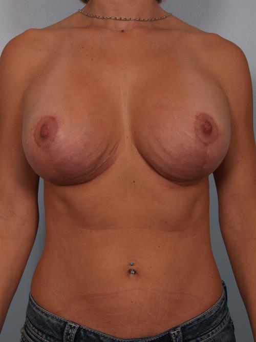 Revision Breast Surgery After Photo | Phoenix and Scottsdale, AZ | Scottsdale Center for Plastic Surgery