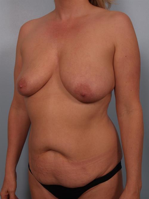Tummy Tuck Before Photo | Phoenix and Scottsdale, AZ | Scottsdale Center for Plastic Surgery