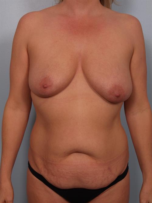 Tummy Tuck Before Photo | Phoenix and Scottsdale, AZ | Scottsdale Center for Plastic Surgery