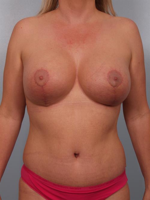 Tummy Tuck After Photo | Phoenix and Scottsdale, AZ | Scottsdale Center for Plastic Surgery