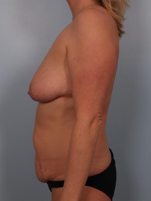 Tummy Tuck Before Photo | Phoenix and Scottsdale, AZ | Scottsdale Center for Plastic Surgery